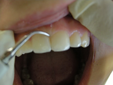 Zahnsteinentfernung mittels Ultraschall - Professionelle Zahnreinigung