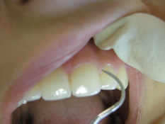 Zahnsteinentfernung mittels scaler - Professionelle Zahnreinigung
