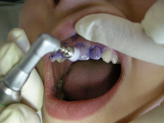 Belagsentfernung - Professionelle Zahnreinigung