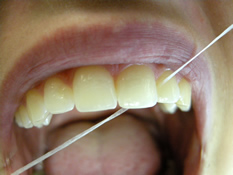 Reinigung der Zahnzwischenräume mit Zahnseide - Professionelle Zahnreinigung