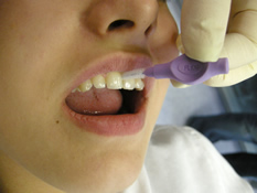 Reinigung der Zahnzwischenräume mit Intradentalbürstchen - Professionelle Zahnreinigung
