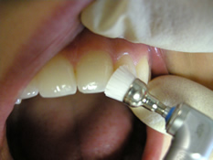 Politur und Fluoridierung - Professionelle Zahnreinigung