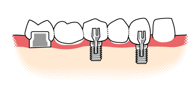 Unterschied zwischen Stiftzahn & Implantat