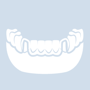 Erfahrungen vollprothese Zahnprothese auf