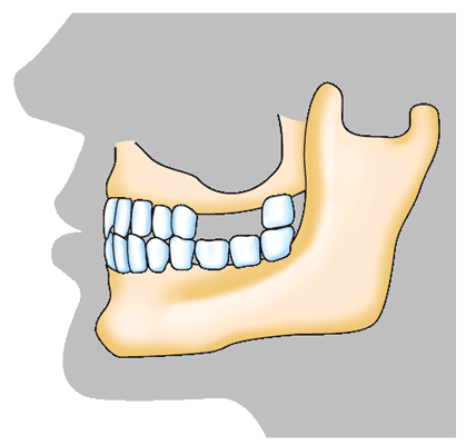 Bild eines dreiteiligen Zahnimplantats