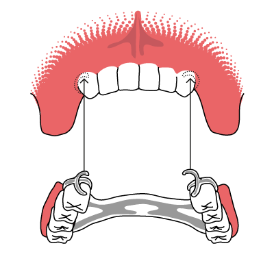 Oberkiefer erfahrungen klammerprothese Klammerprothese (Modellgussprothese)