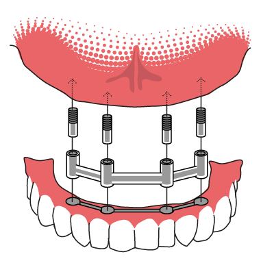 Erfahrung implantat zahn Alternative zum