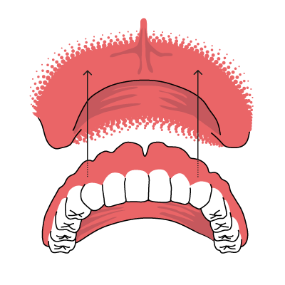 Zahnersatz ohne gaumenplatte herausnehmbarer Die Vollprothese